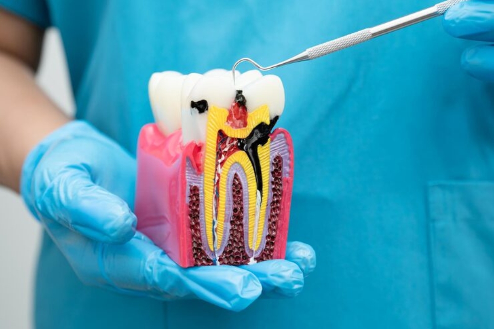 Save Your Natural Tooth With Root Canal Therapy